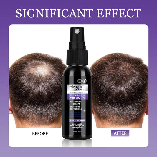 Nährendes Anti-Haarausfall Minoxidil Haarpflegespray